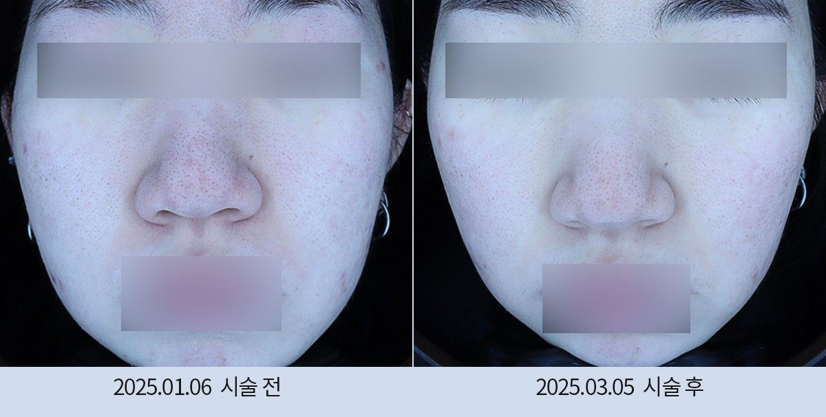 스노우의원 다산점 여드름·붉은기 시술 전후
