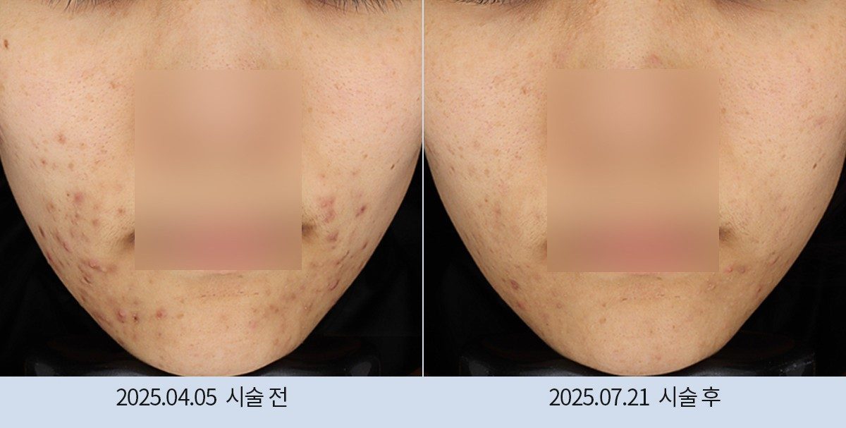 스노우의원 다산점 여드름·붉은기 시술 전후