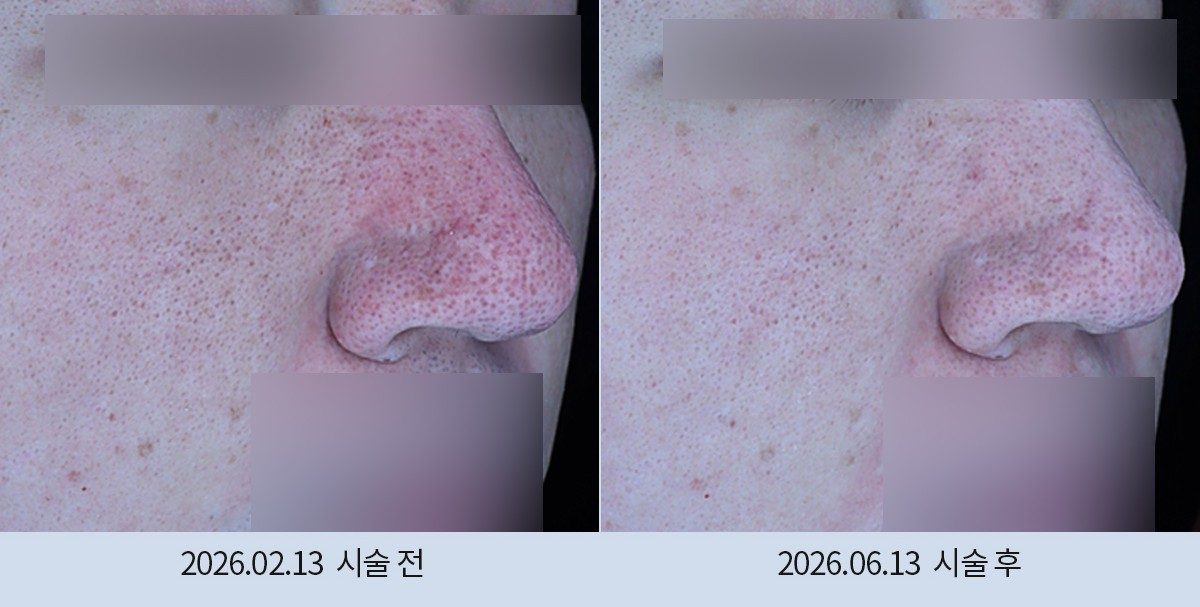 스노우의원 다산점 모공·흉터 시술 전후