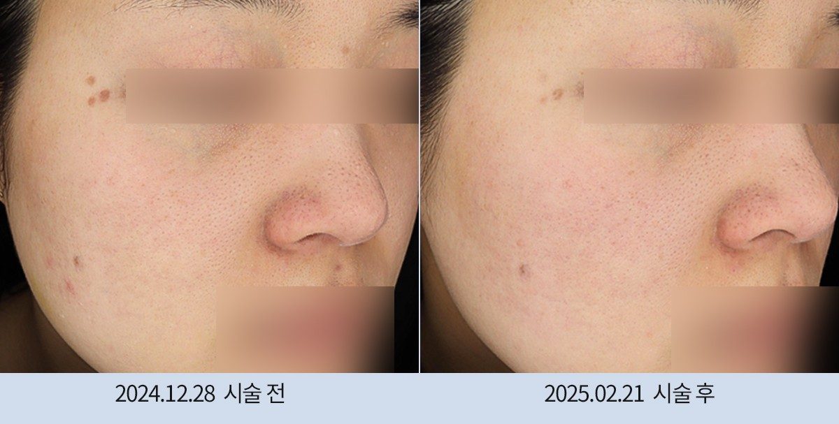 스노우의원 다산점 모공·흉터 시술 전후